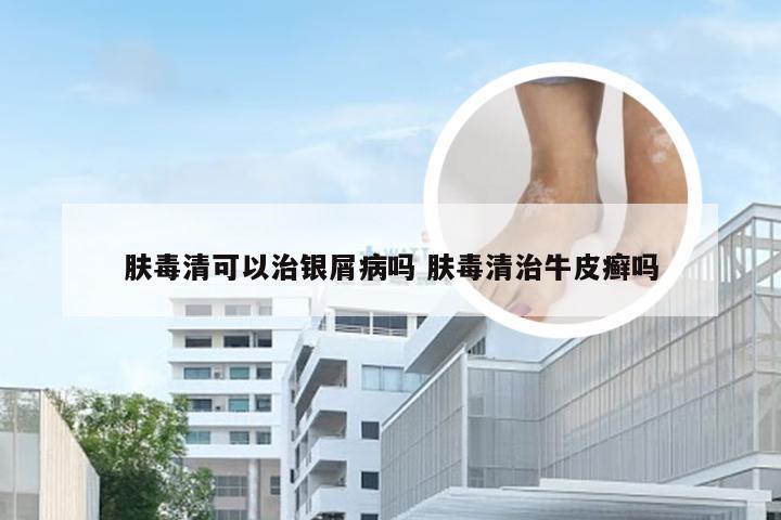 肤毒清可以治银屑病吗 肤毒清治牛皮癣吗