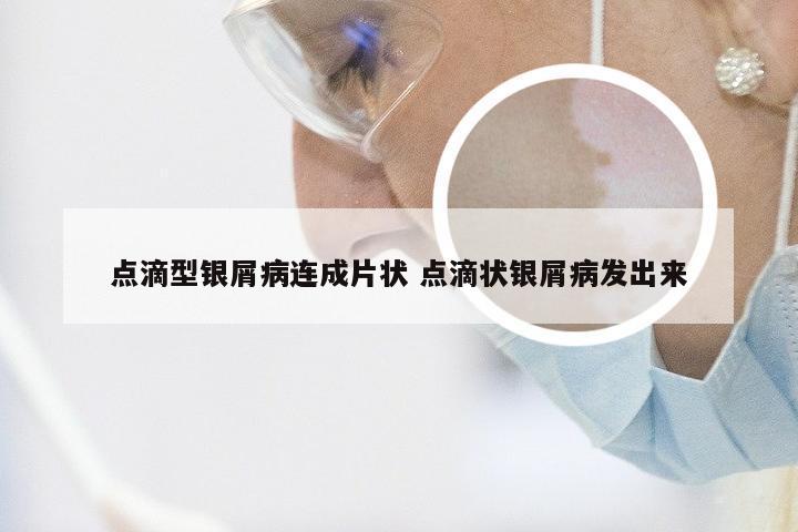 点滴型银屑病连成片状 点滴状银屑病发出来