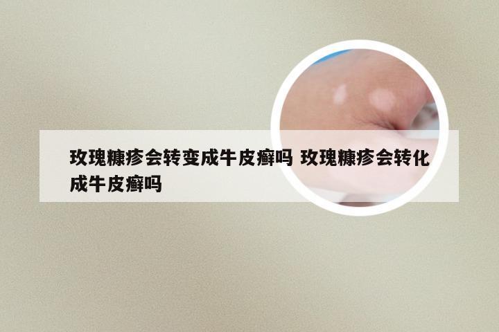 玫瑰糠疹会转变成牛皮癣吗 玫瑰糠疹会转化成牛皮癣吗