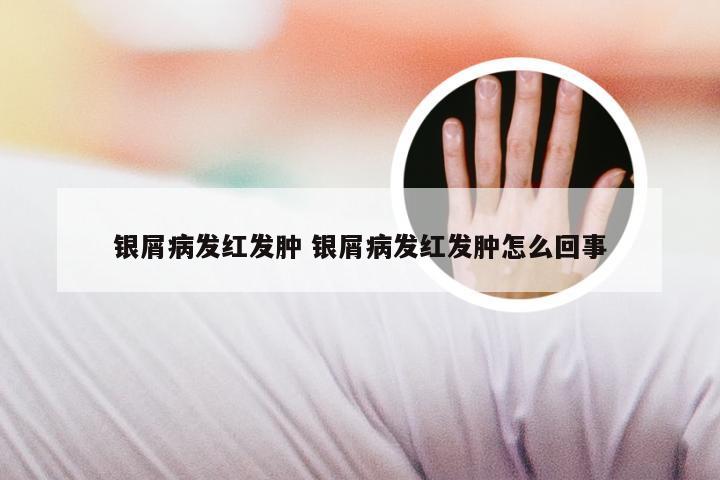 银屑病发红发肿 银屑病发红发肿怎么回事