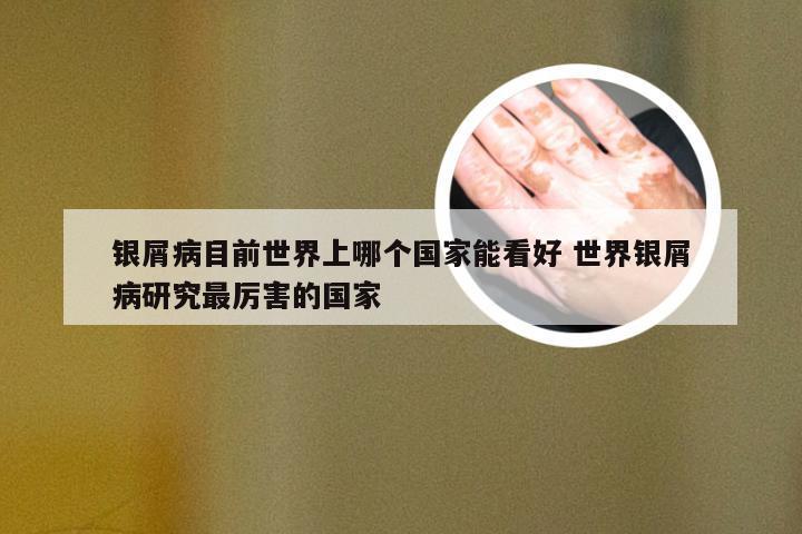 银屑病目前世界上哪个国家能看好 世界银屑病研究最厉害的国家