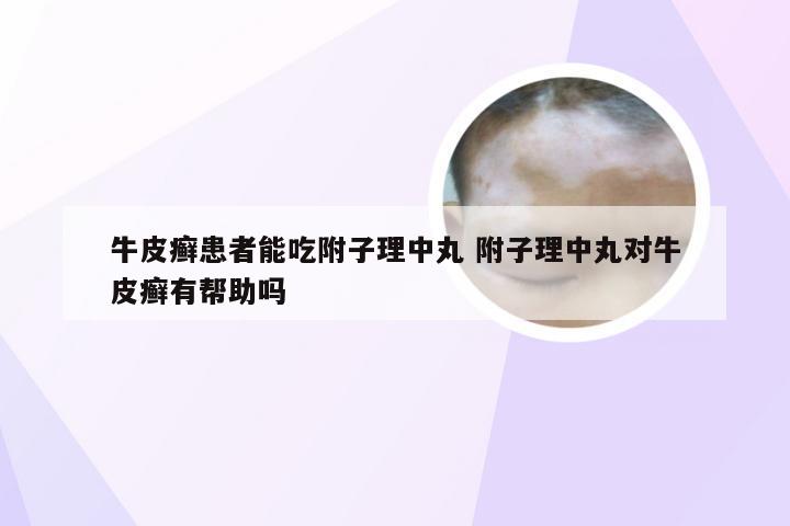 牛皮癣患者能吃附子理中丸 附子理中丸对牛皮癣有帮助吗