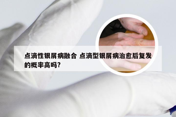 点滴性银屑病融合 点滴型银屑病治愈后复发的概率高吗?