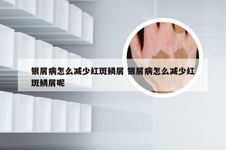 银屑病怎么减少红斑鳞屑 银屑病怎么减少红斑鳞屑呢