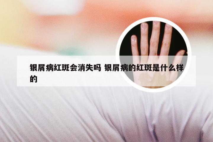银屑病红斑会消失吗 银屑病的红斑是什么样的