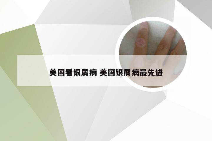 美国看银屑病 美国银屑病最先进