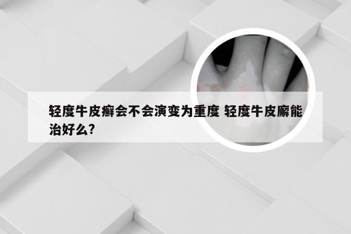 轻度牛皮癣会不会演变为重度 轻度牛皮廨能治好么?