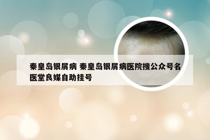秦皇岛银屑病 秦皇岛银屑病医院搜公众号名医堂良媒自助挂号