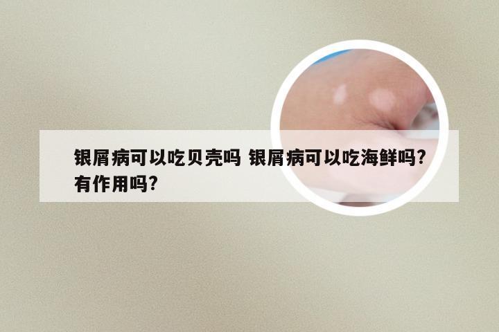 银屑病可以吃贝壳吗 银屑病可以吃海鲜吗?有作用吗?