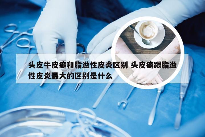头皮牛皮癣和脂溢性皮炎区别 头皮癣跟脂溢性皮炎最大的区别是什么