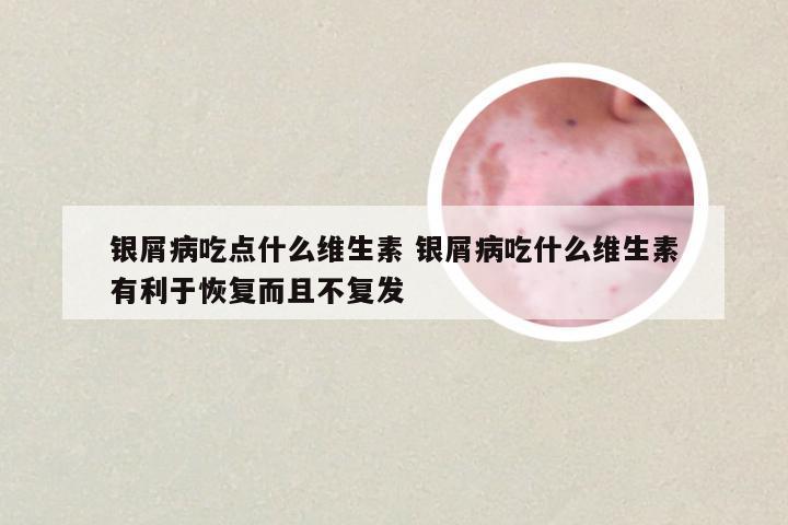 银屑病吃点什么维生素 银屑病吃什么维生素有利于恢复而且不复发