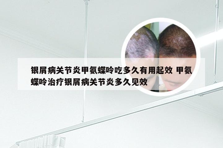 银屑病关节炎甲氨蝶呤吃多久有用起效 甲氨蝶呤治疗银屑病关节炎多久见效
