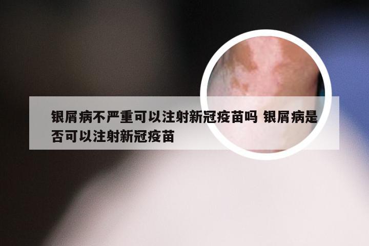银屑病不严重可以注射新冠疫苗吗 银屑病是否可以注射新冠疫苗