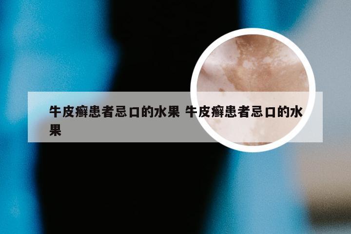 牛皮癣患者忌口的水果 牛皮癣患者忌口的水果