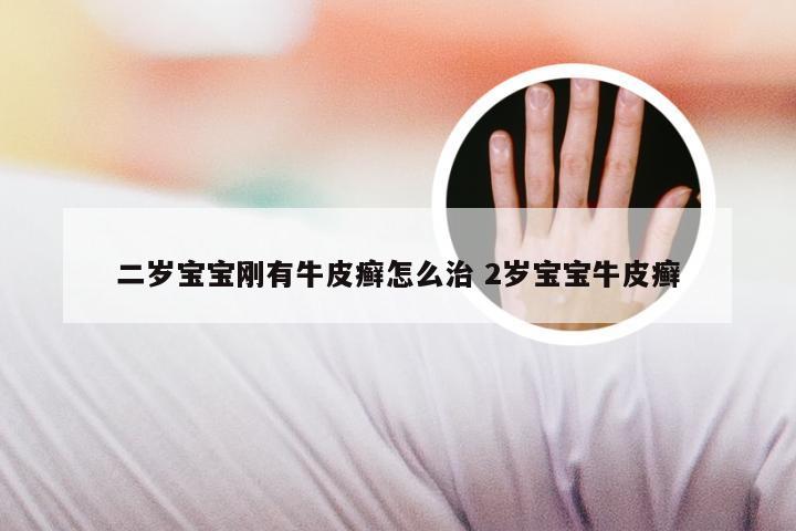 二岁宝宝刚有牛皮癣怎么治 2岁宝宝牛皮癣