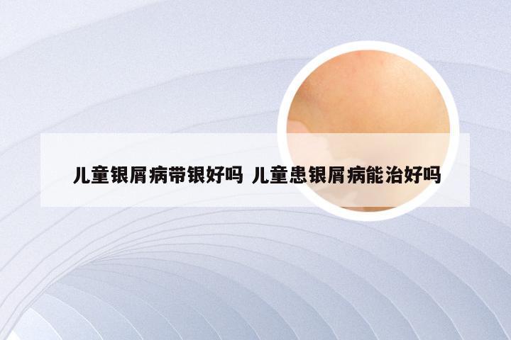 儿童银屑病带银好吗 儿童患银屑病能治好吗