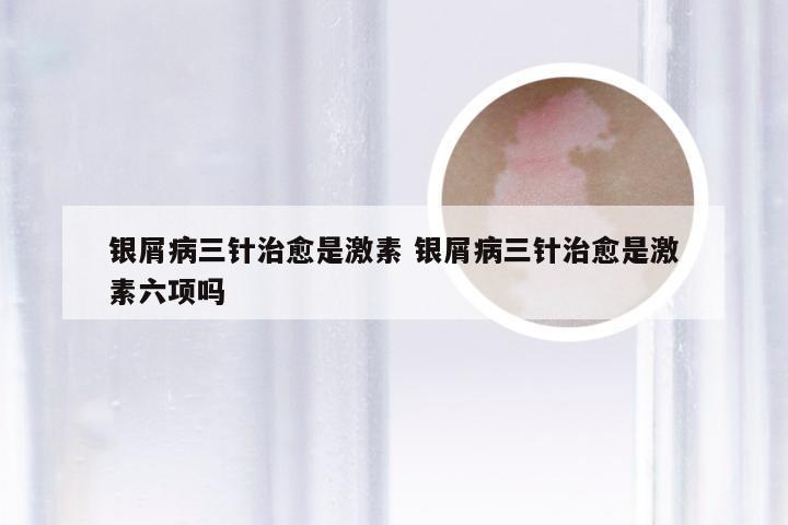 银屑病三针治愈是激素 银屑病三针治愈是激素六项吗
