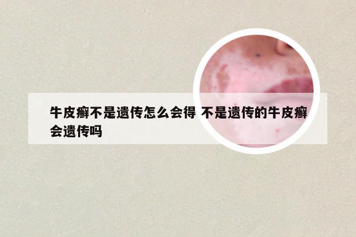牛皮癣不是遗传怎么会得 不是遗传的牛皮癣会遗传吗