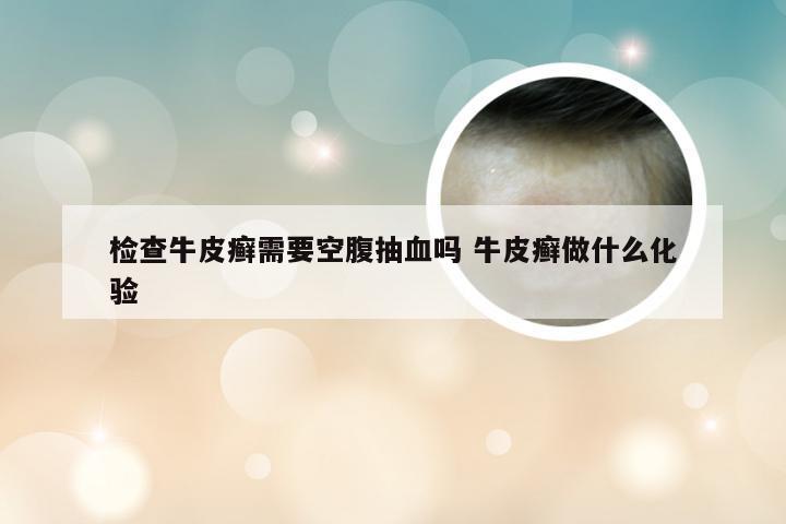 检查牛皮癣需要空腹抽血吗 牛皮癣做什么化验