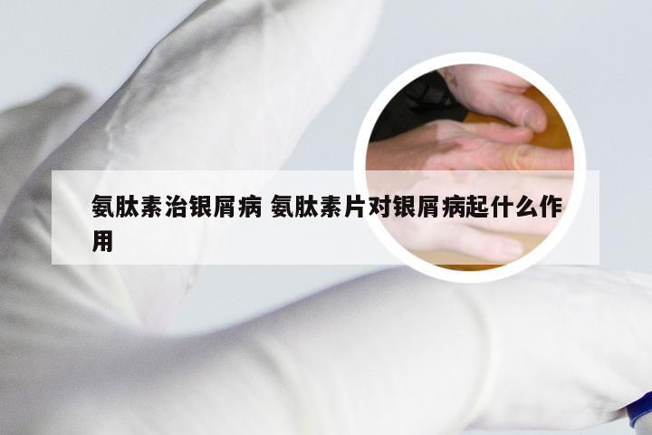 氨肽素治银屑病 氨肽素片对银屑病起什么作用