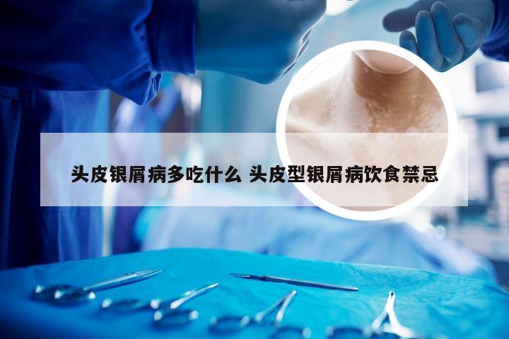 头皮银屑病多吃什么 头皮型银屑病饮食禁忌