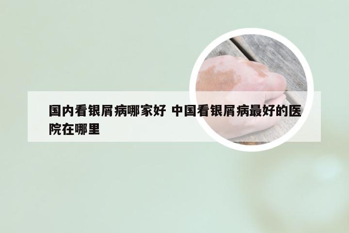 国内看银屑病哪家好 中国看银屑病最好的医院在哪里