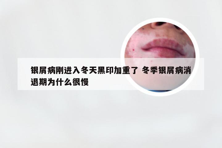 银屑病刚进入冬天黑印加重了 冬季银屑病消退期为什么很慢