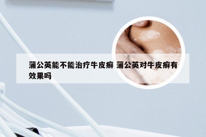 蒲公英能不能治疗牛皮癣 蒲公英对牛皮癣有效果吗
