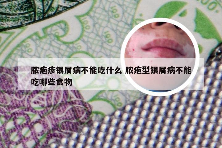脓疱疹银屑病不能吃什么 脓疱型银屑病不能吃哪些食物
