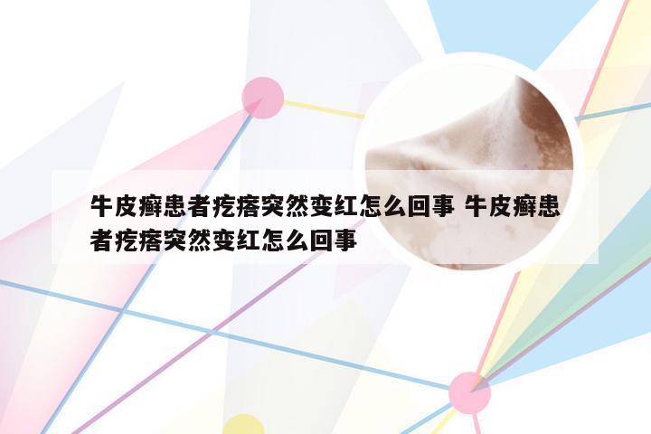 牛皮癣患者疙瘩突然变红怎么回事 牛皮癣患者疙瘩突然变红怎么回事