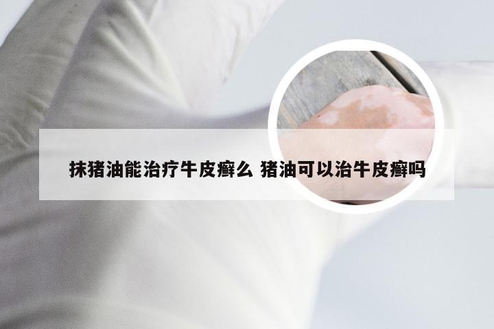 抹猪油能治疗牛皮癣么 猪油可以治牛皮癣吗