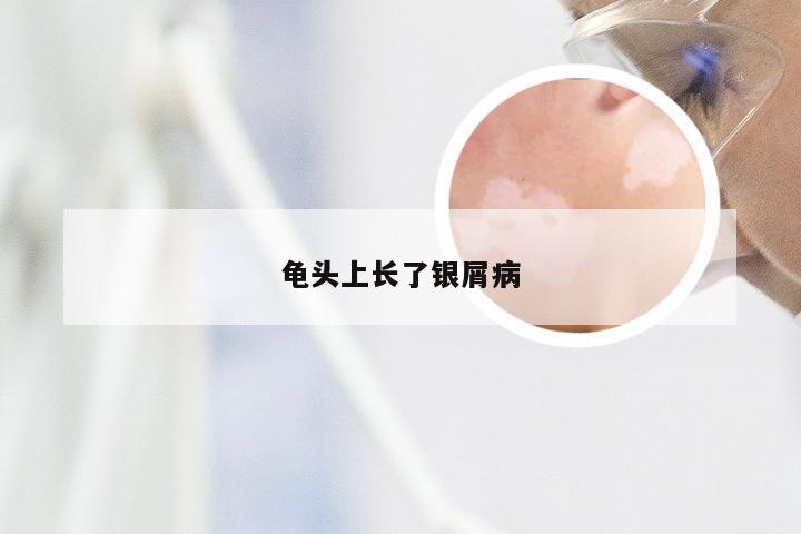 龟头上长了银屑病