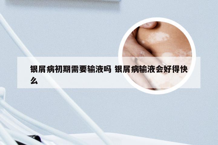 银屑病初期需要输液吗 银屑病输液会好得快么
