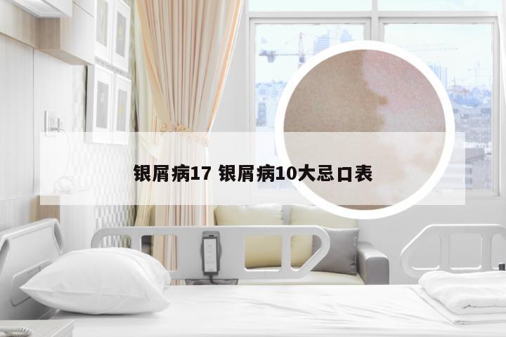 银屑病17 银屑病10大忌口表