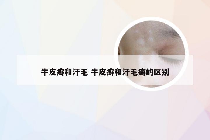 牛皮癣和汗毛 牛皮癣和汗毛癣的区别