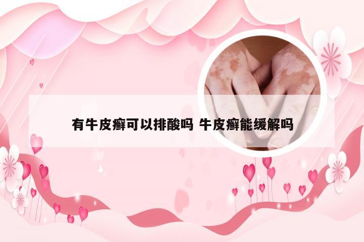 有牛皮癣可以排酸吗 牛皮癣能缓解吗