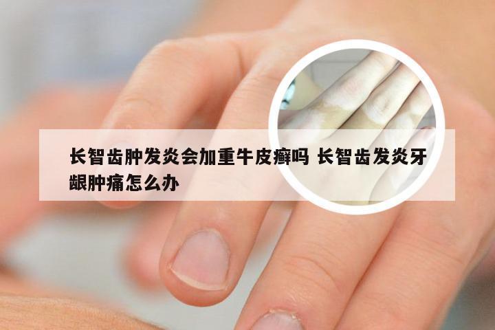 长智齿肿发炎会加重牛皮癣吗 长智齿发炎牙龈肿痛怎么办