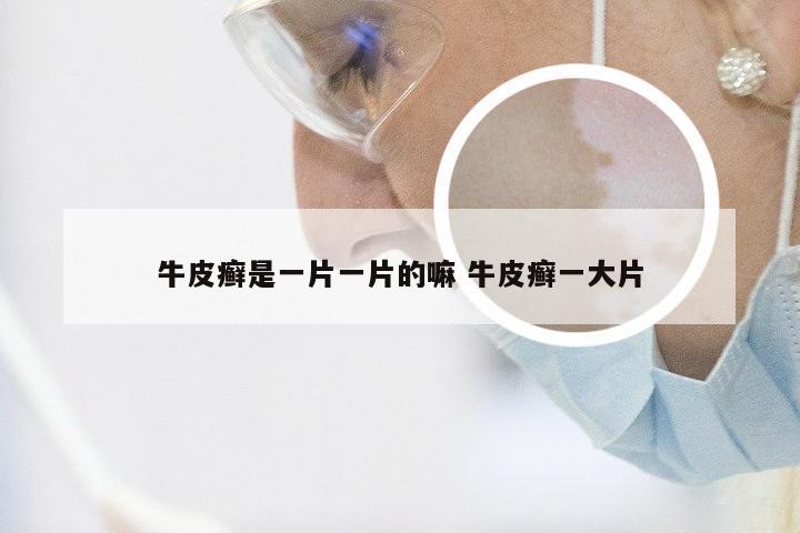 牛皮癣是一片一片的嘛 牛皮癣一大片