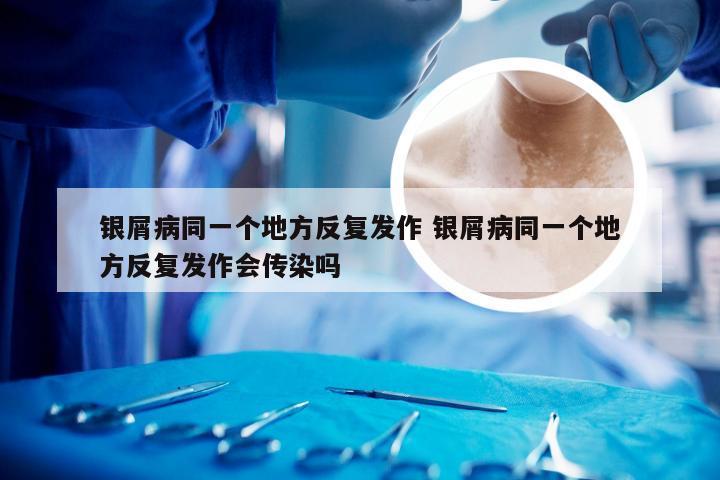 银屑病同一个地方反复发作 银屑病同一个地方反复发作会传染吗
