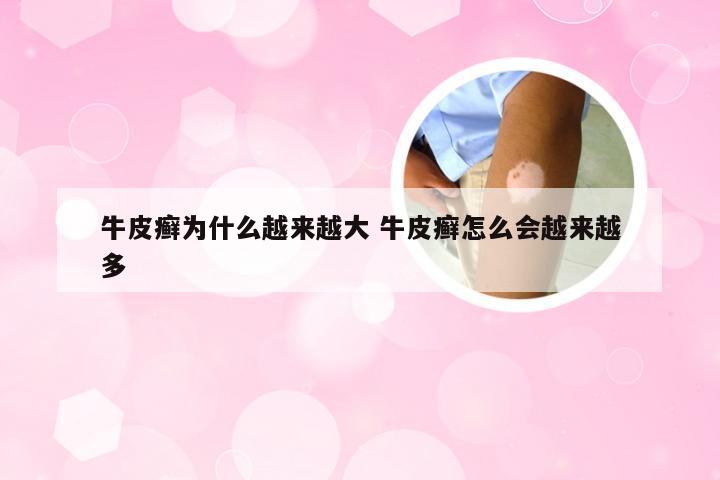 牛皮癣为什么越来越大 牛皮癣怎么会越来越多