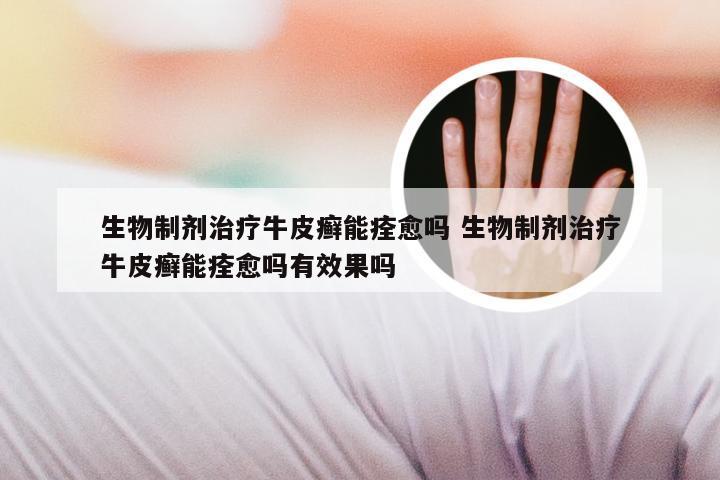 生物制剂治疗牛皮癣能痊愈吗 生物制剂治疗牛皮癣能痊愈吗有效果吗