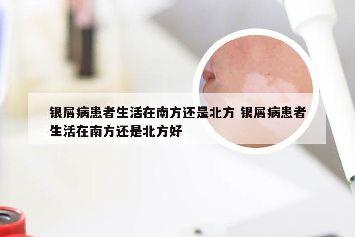 银屑病患者生活在南方还是北方 银屑病患者生活在南方还是北方好