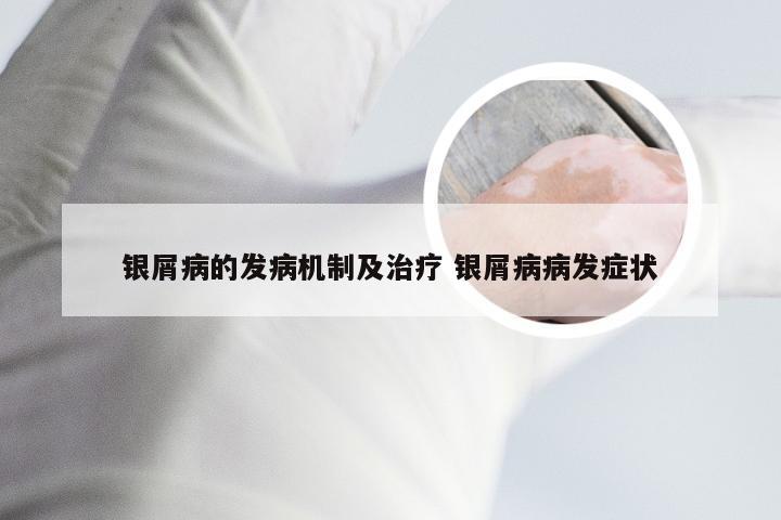 银屑病的发病机制及治疗 银屑病病发症状