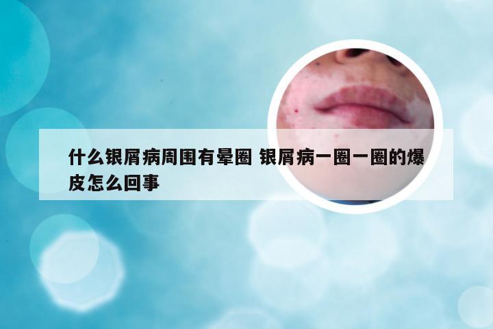 什么银屑病周围有晕圈 银屑病一圈一圈的爆皮怎么回事