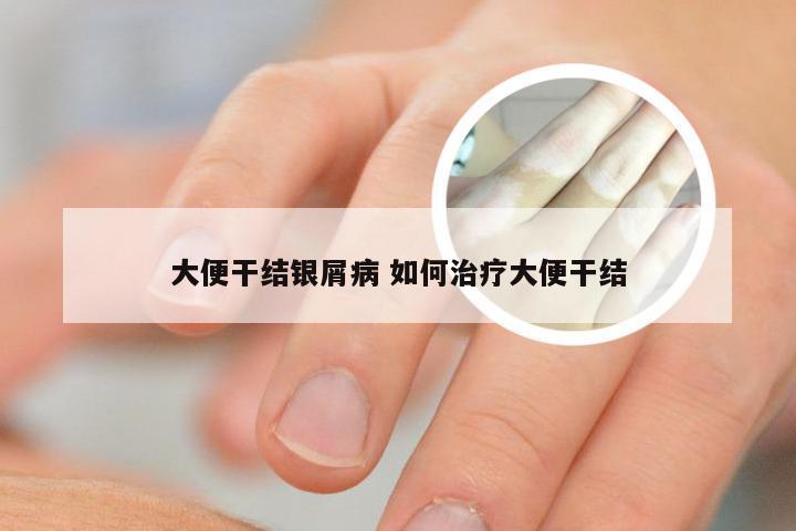 大便干结银屑病 如何治疗大便干结