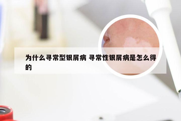 为什么寻常型银屑病 寻常性银屑病是怎么得的
