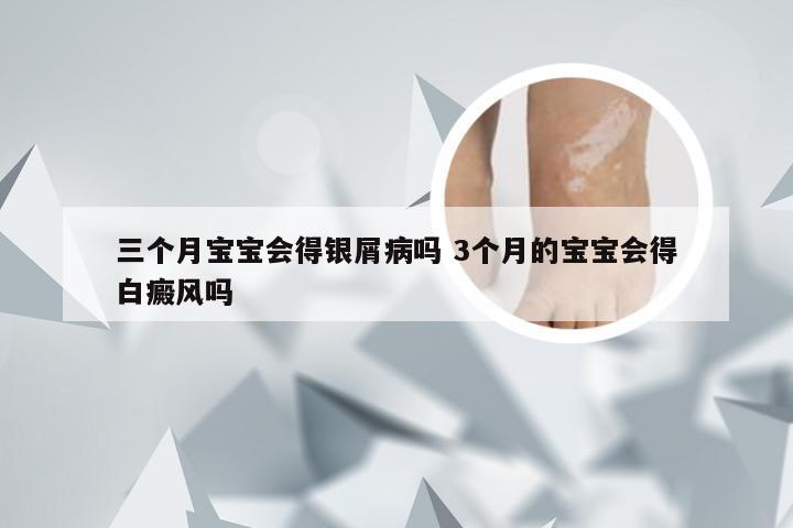 三个月宝宝会得银屑病吗 3个月的宝宝会得白癜风吗