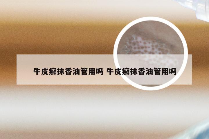 牛皮癣抹香油管用吗 牛皮癣抹香油管用吗