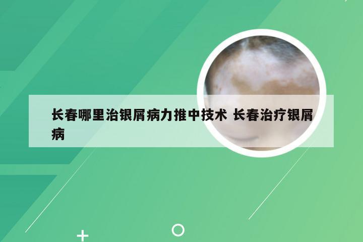 长春哪里治银屑病力推中技术 长春治疗银屑病