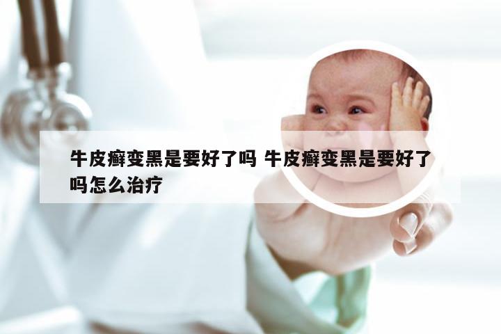 牛皮癣变黑是要好了吗 牛皮癣变黑是要好了吗怎么治疗